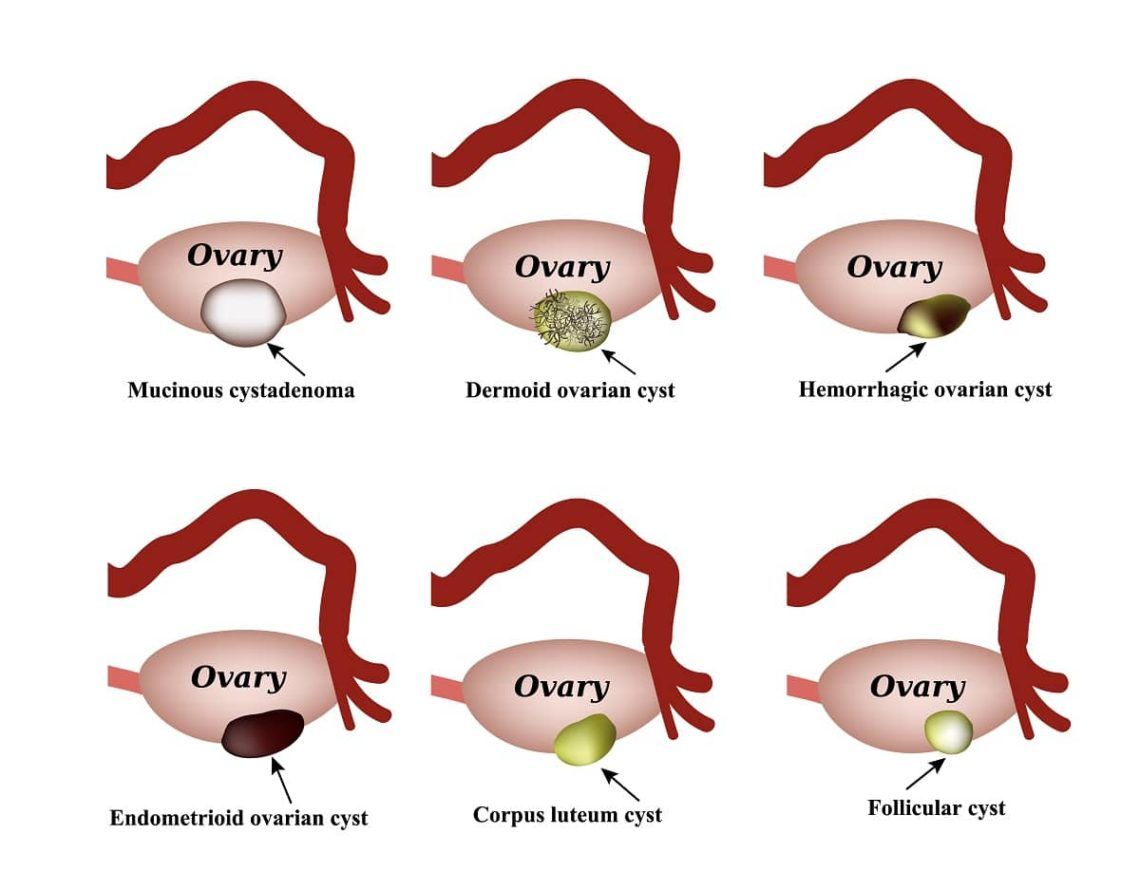 ruptured ovarian cyst bleeding